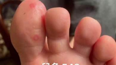 新冠病毒又有新特殊症狀？COVID腳趾「有時會發癢，有時會很痛苦」！